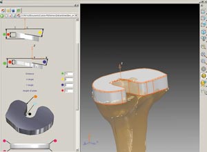 Рис. 17. Перемычка для реконструкции челюсти и программа для моделирования прокладки для сустава большой берцовой кости